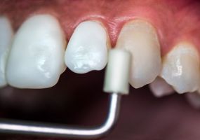 cursos implantologia dental cartagena Matizz Dental Veneers