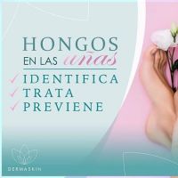 Hongos en las uñas